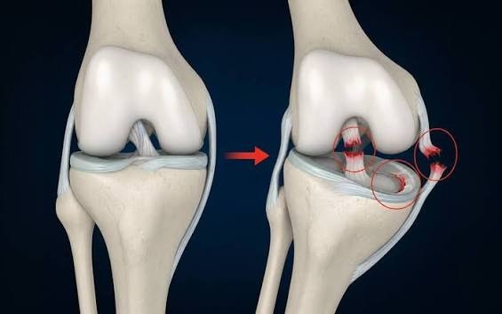 Hearing the "Pop": Do All ACL Tears Actually Require Surgery?