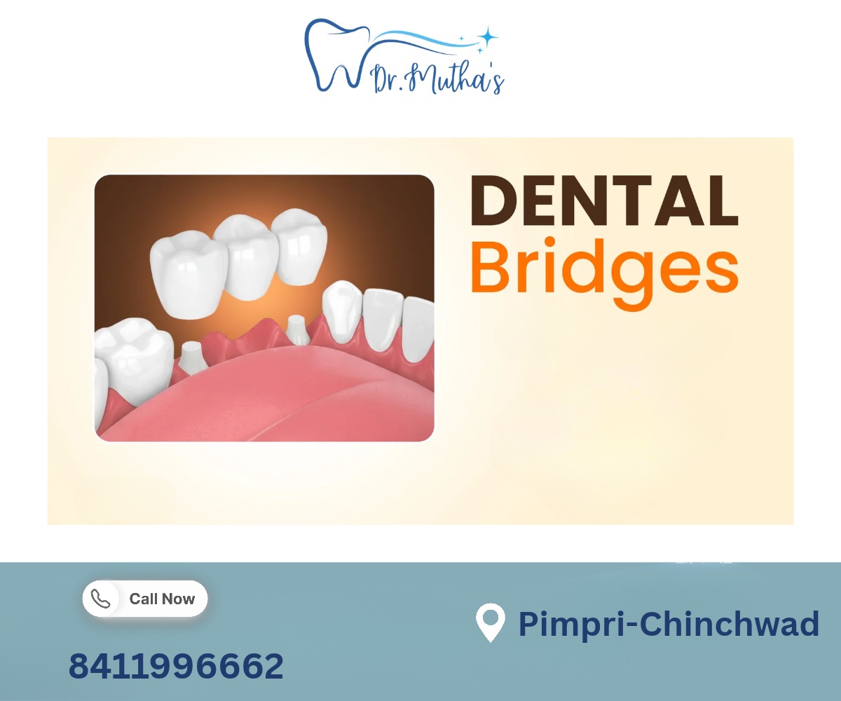 Dental Bridges to Replace Missing Teeth: What Patients Should Know